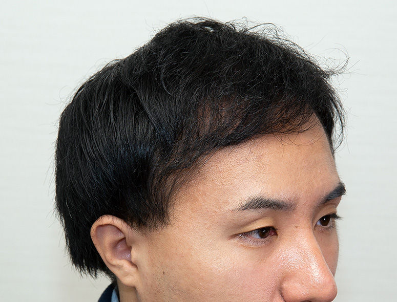 30代 男性 K.Hさんの頭部写真3（術後9ヶ月）
