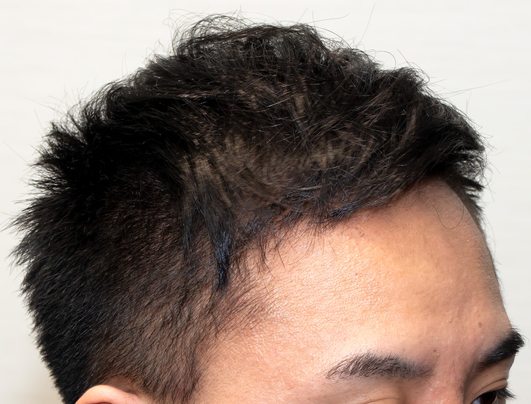 30代 男性 K.Hさんの頭部写真3（術後2年8ヶ月）
