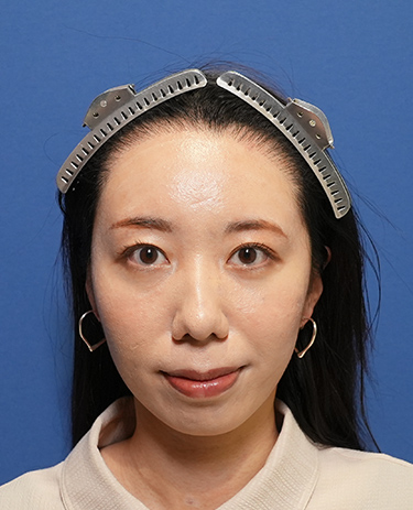 女性A.Mさんの顔写真（施術後）