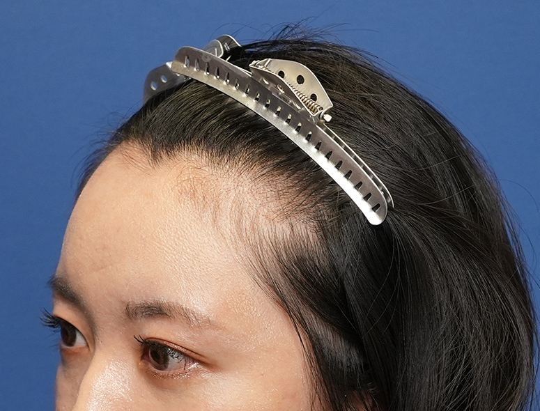 女性A.Mさんの頭部写真1（施術前）
