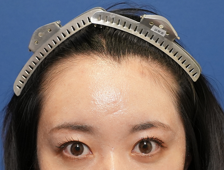 女性A.Mさんの頭部写真2（施術前）