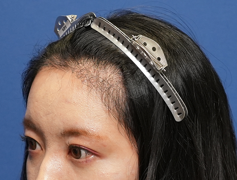 女性A.Mさんの頭部写真1（術後5ヶ月）