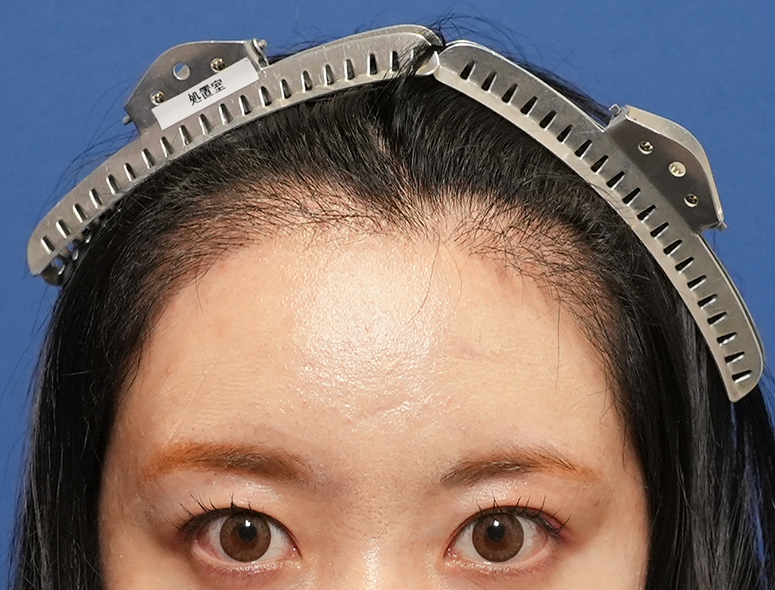 女性A.Mさんの頭部写真2（術後5ヶ月）