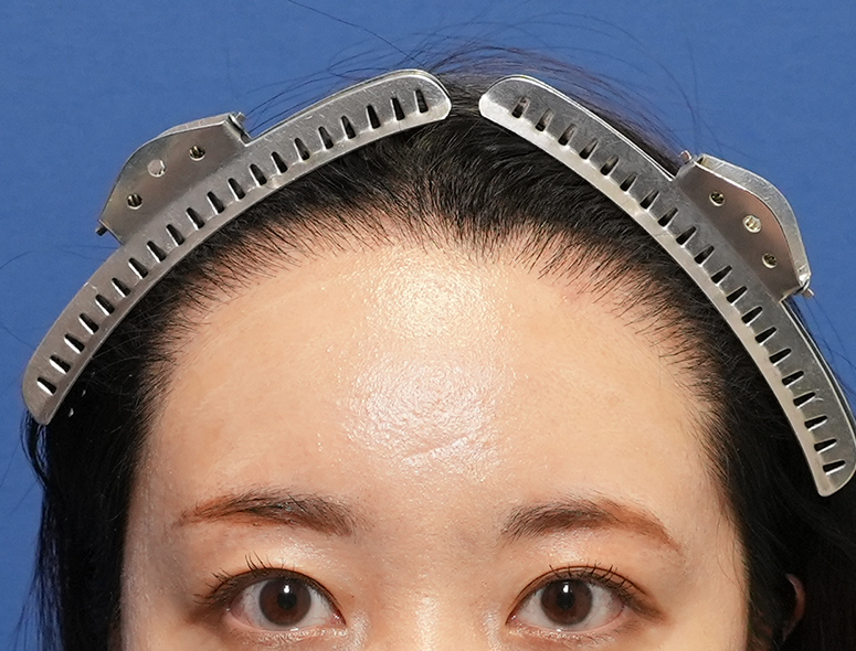 女性A.Mさんの頭部写真2（施術後）