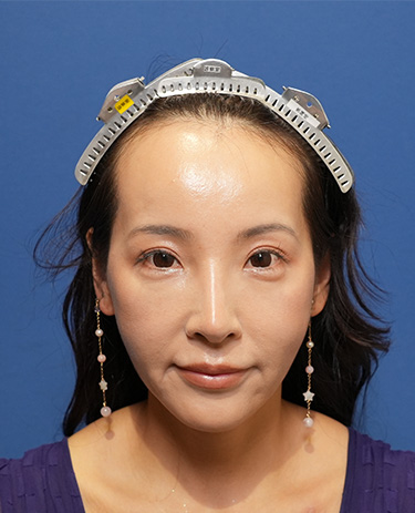 女性S.Mさんの顔写真（施術前）