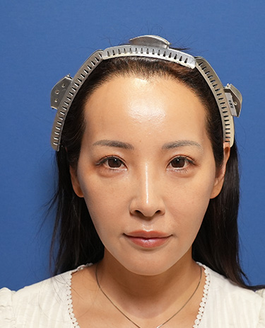 女性S.Mさんの顔写真（施術後）