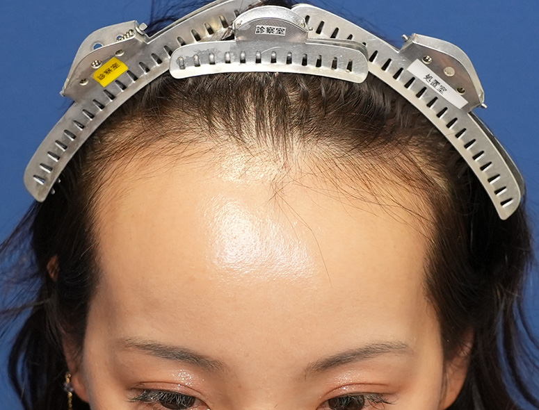 女性S.Mさんの頭部写真2（施術前）