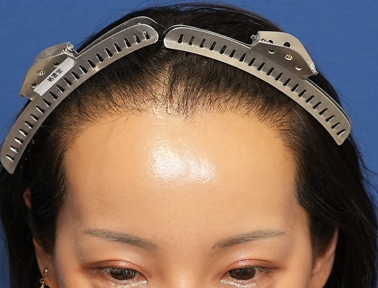 女性S.Mさんの頭部写真2（術後5ヶ月）