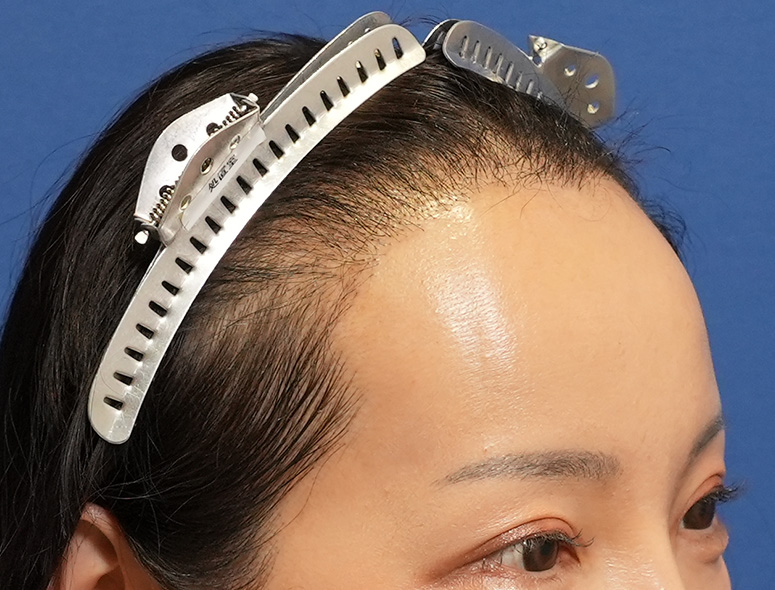 女性S.Mさんの頭部写真3（術後5ヶ月）