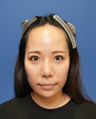 女性O.Mさんの顔写真（術前）