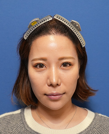 女性O.Mさんの顔写真（術後9ヶ月）