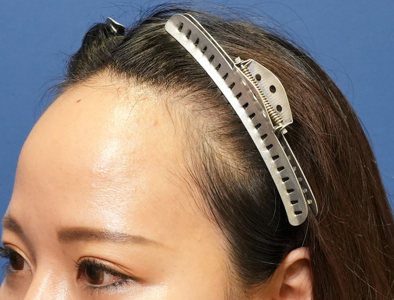 女性O.Mさんの頭部写真1（施術前）