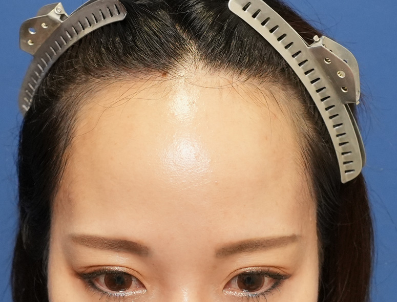 女性O.Mさんの頭部写真2（術前）