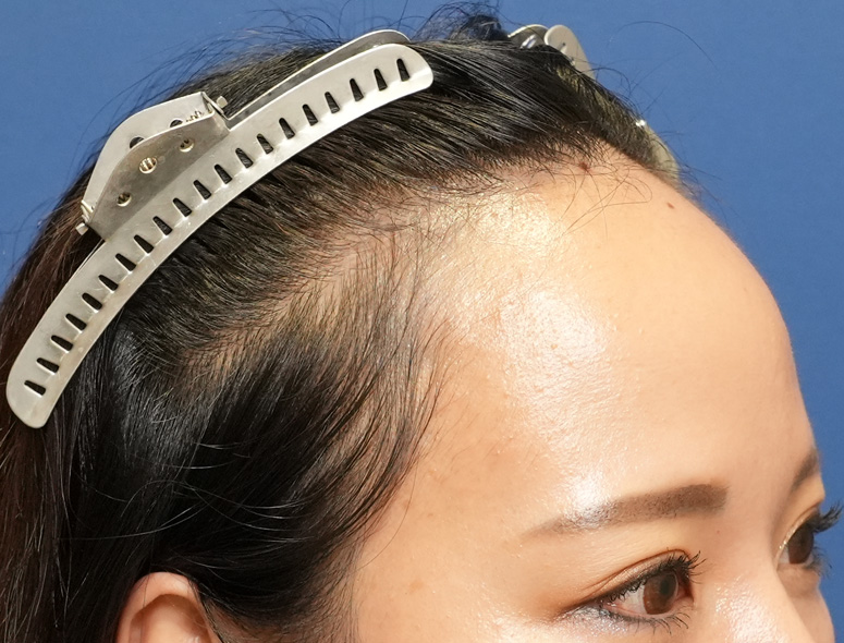 女性O.Mさんの頭部写真3（施術前）