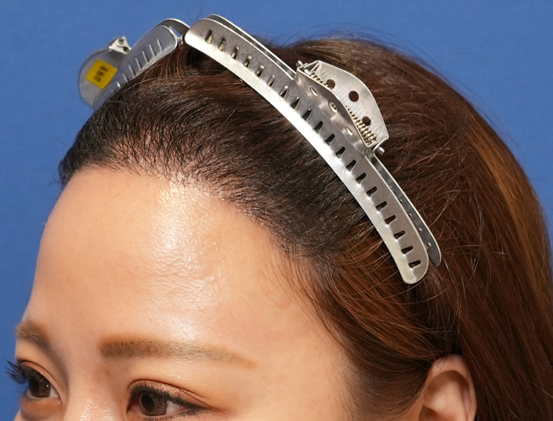 女性O.Mさんの頭部写真1（術後10日）
