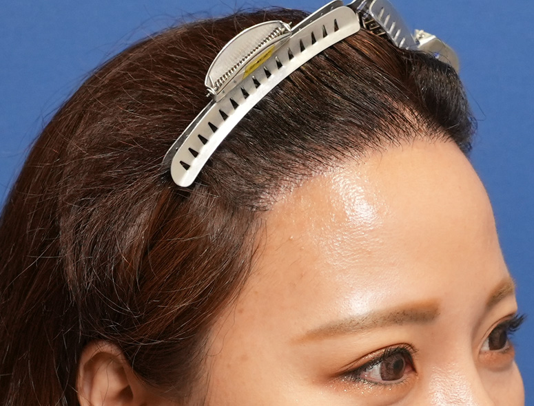女性O.Mさんの頭部写真3（術後9ヶ月）