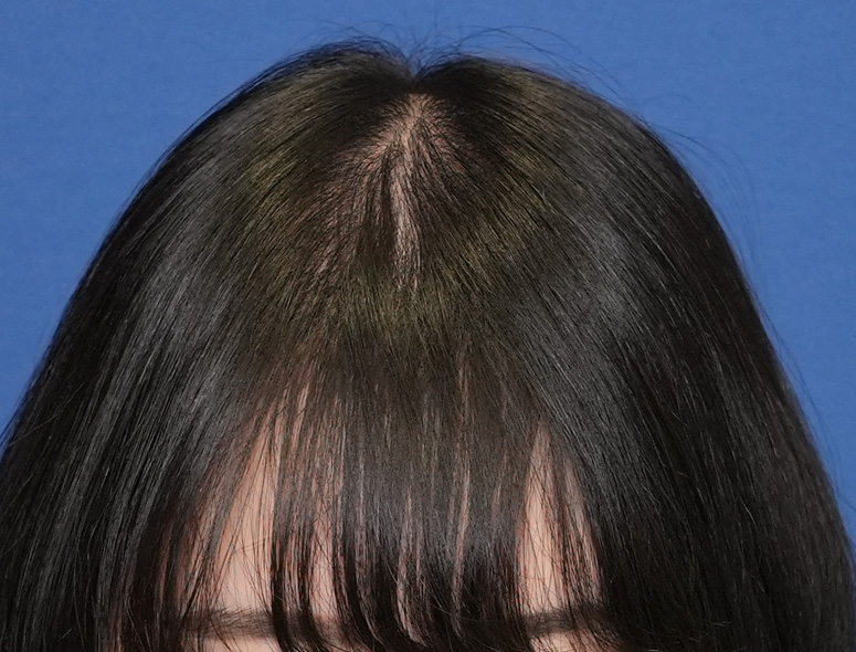 女性S.Mさんの頭部写真2（施術後）