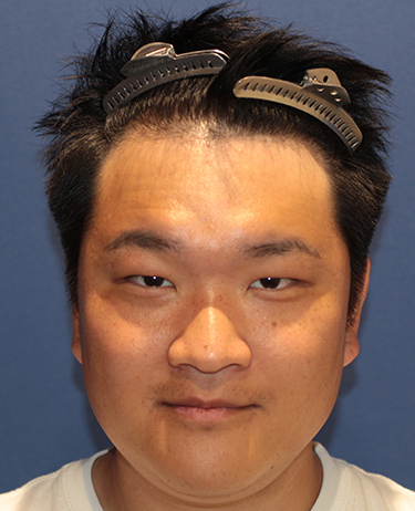 男性 トミックさんの顔写真（術前）