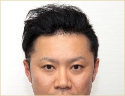 30代 男性 T.Mさんの顔写真（1年2ヶ月後）