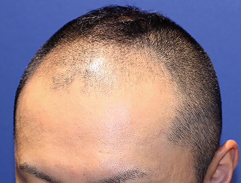 30代 男性 T.Mさんの頭部写真1（施術前）