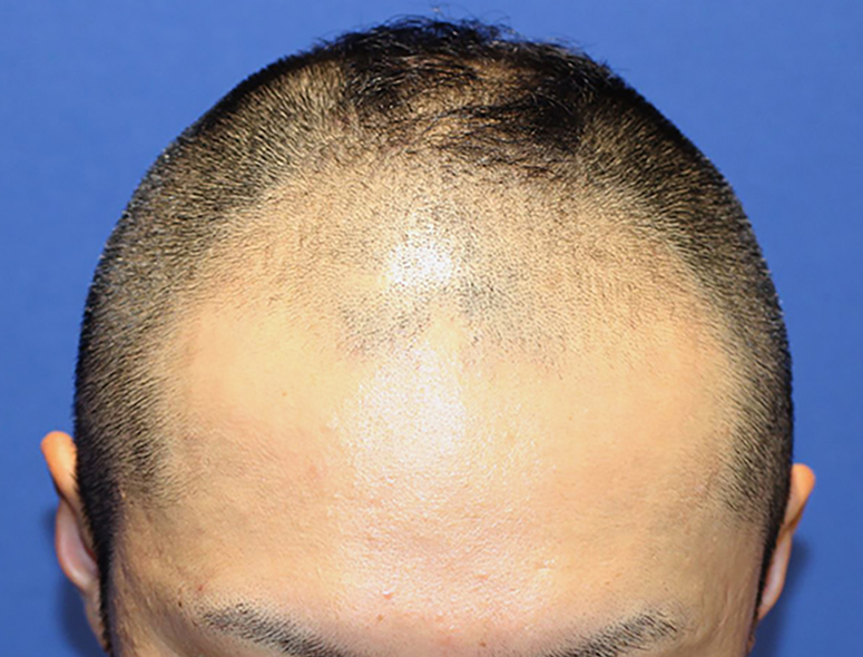 30代 男性 T.Mさんの頭部写真2（施術前）