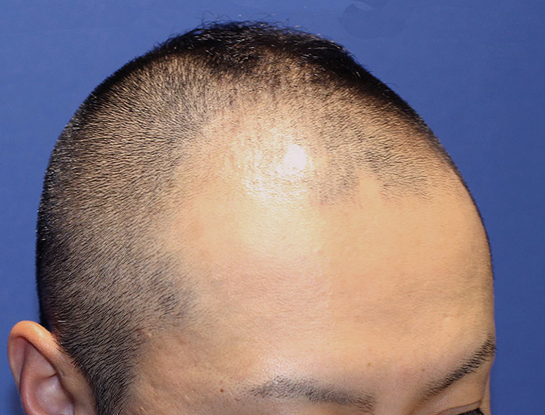 30代 男性 T.Mさんの頭部写真3（施術前）