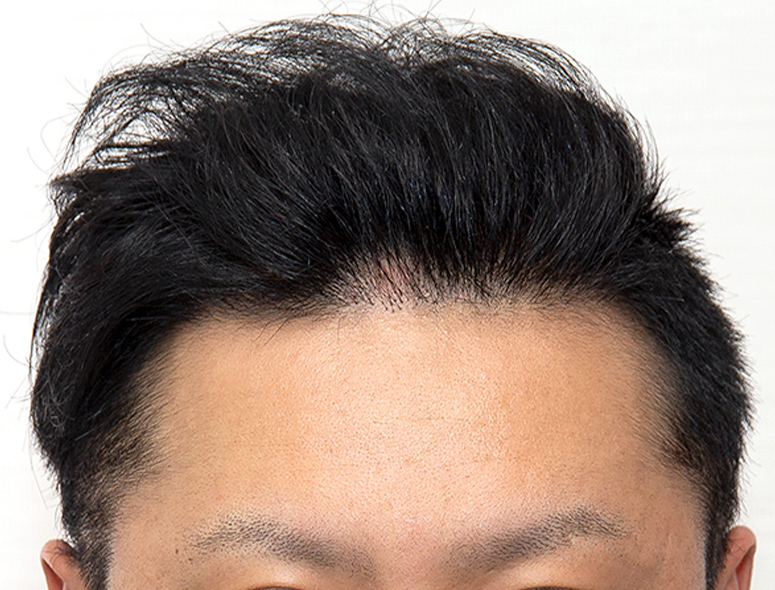 30代 男性 T.Mさんの頭部写真2（1年2ヶ月後）