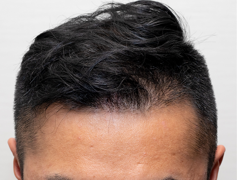 30代 男性 T.Mさんの頭部写真2（3年後）