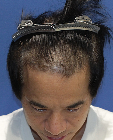 男性 O.T.さんの顔写真（施術前）