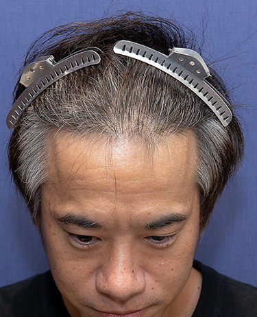 男性 O.T.さんの顔写真（術後1年）