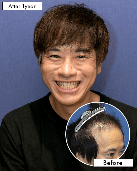 O.T.さんの上半身写真（施術後）