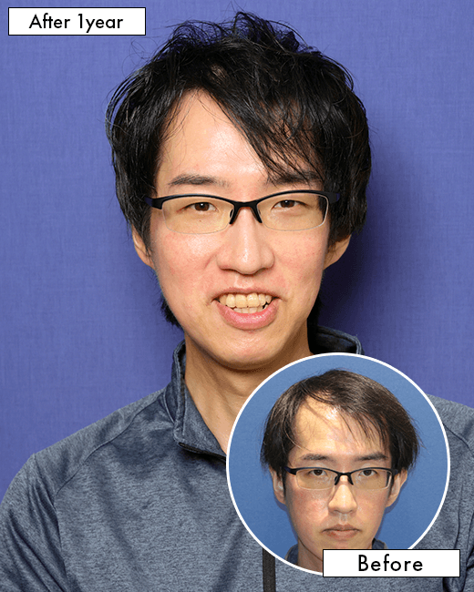 S.Y.さんの上半身写真（術後1年）