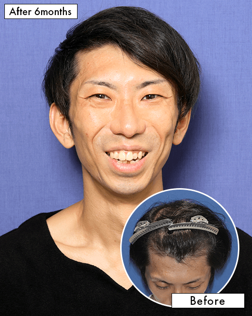 S.Y.さんの上半身写真（術後6ヶ月）