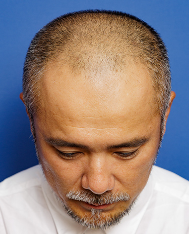 男性 中村 彰宏さんの顔写真（施術前）