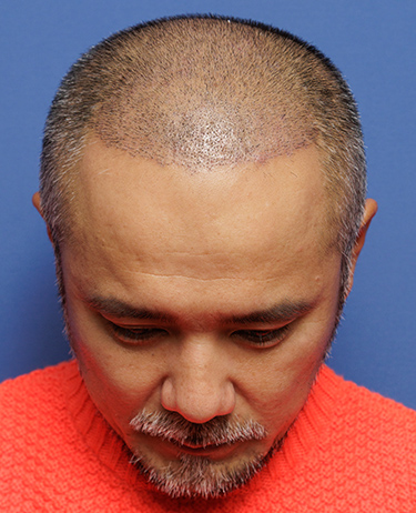 男性 中村 彰宏さんの顔写真（術後10日目）