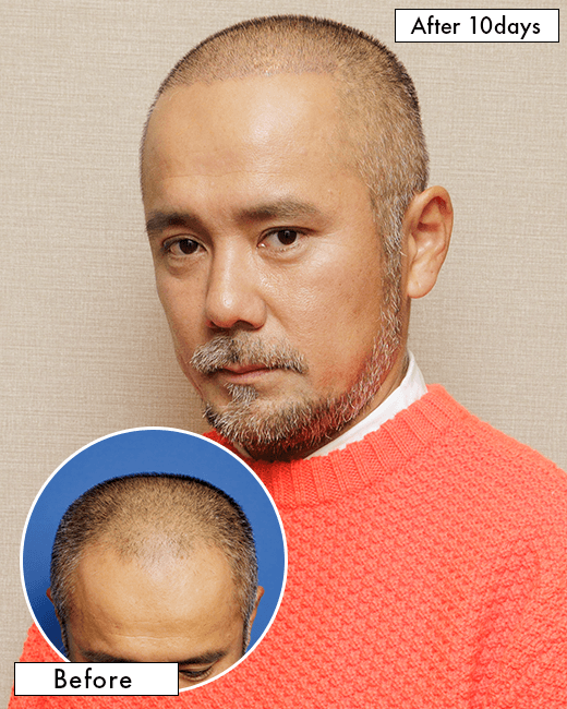 中村 彰宏さんの上半身写真（術後10日目）