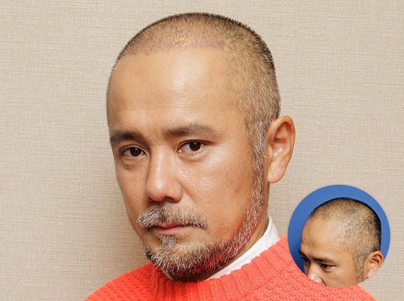 40代男性 中村 彰宏の上半身写真（施術後）＋施術前写真