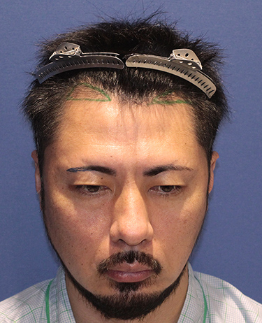 男性 G.D.さんの顔写真（施術前）