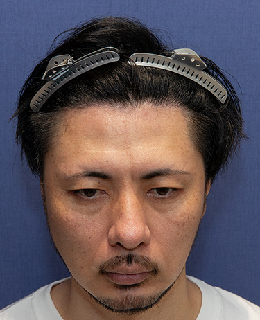 男性 G.D.さんの顔写真（術後10日目）