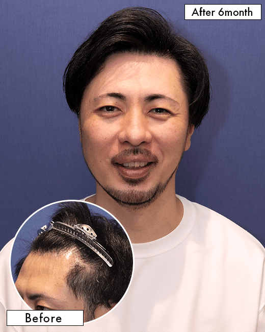 G.D.さんの上半身写真（術後10日目）