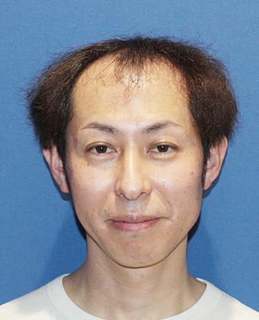 男性 K.Y.さんの顔写真（施術前）