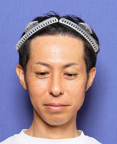 男性 K.Y.さんの顔写真（術後6ヶ月）