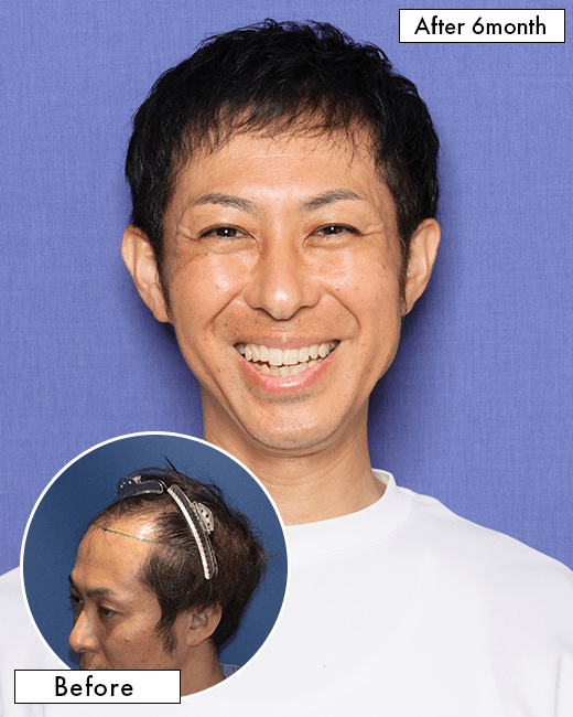 K.Y.さんの上半身写真（術後6ヶ月）