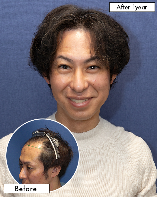 K.Y.さんの上半身写真（術後6ヶ月）