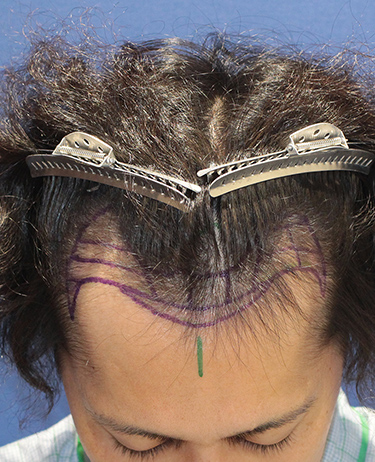 男性 O.K.さんの顔写真（施術前）