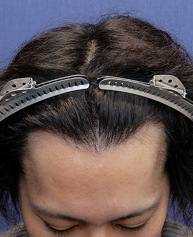 男性 O.K.さんの顔写真（術後10日目）