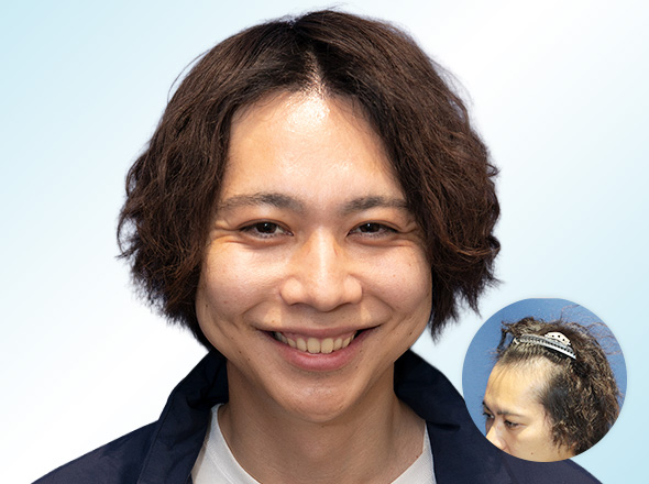 30代男性 O.K.の上半身写真（施術後）＋施術前写真