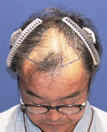 男性 A.R.さんの顔写真（施術前）