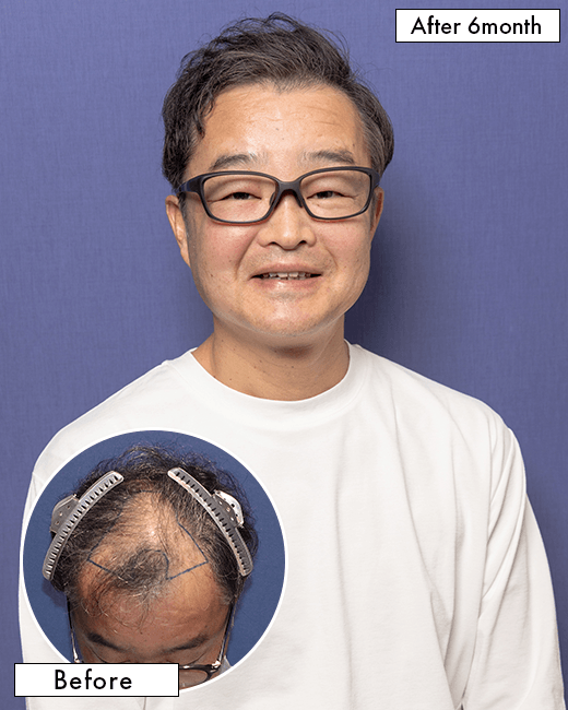 A.R.さんの上半身写真（術後6ヶ月）