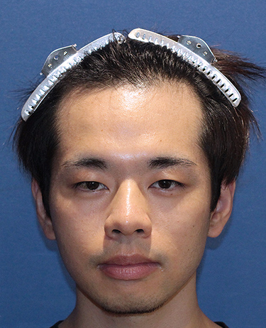 男性 S.S.さんの顔写真（施術前）